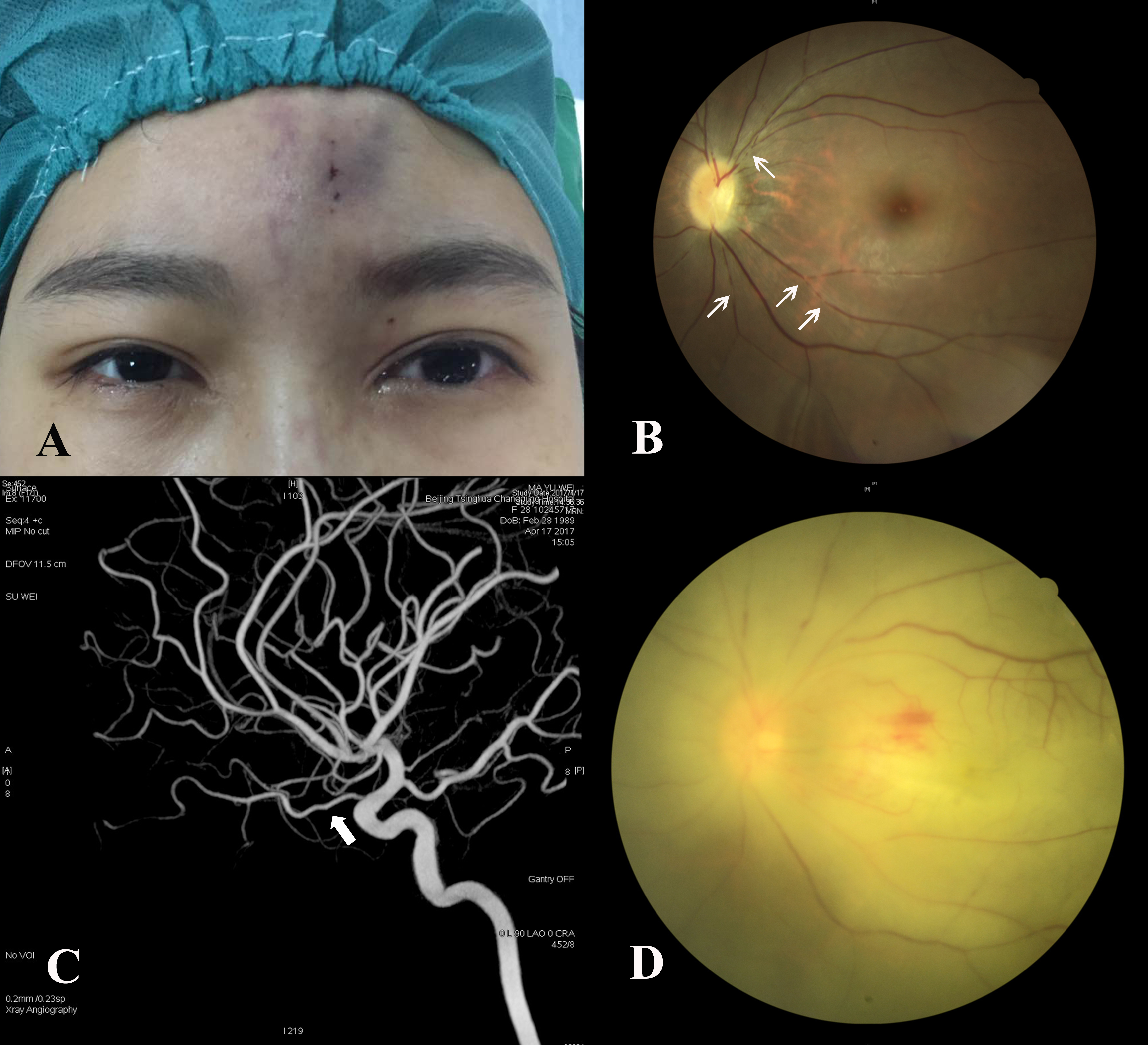 A new injury severity scale for ocular complications following ...
