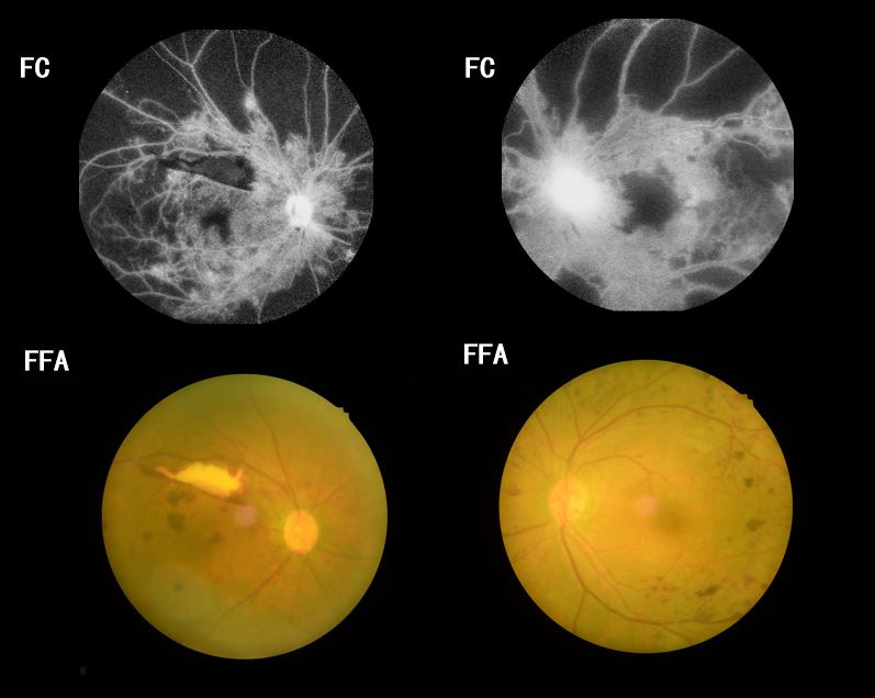 Voxel-based morphometry reveals altered gray matter volume related to  cognitive dysfunctioning in neovascular glaucoma patients