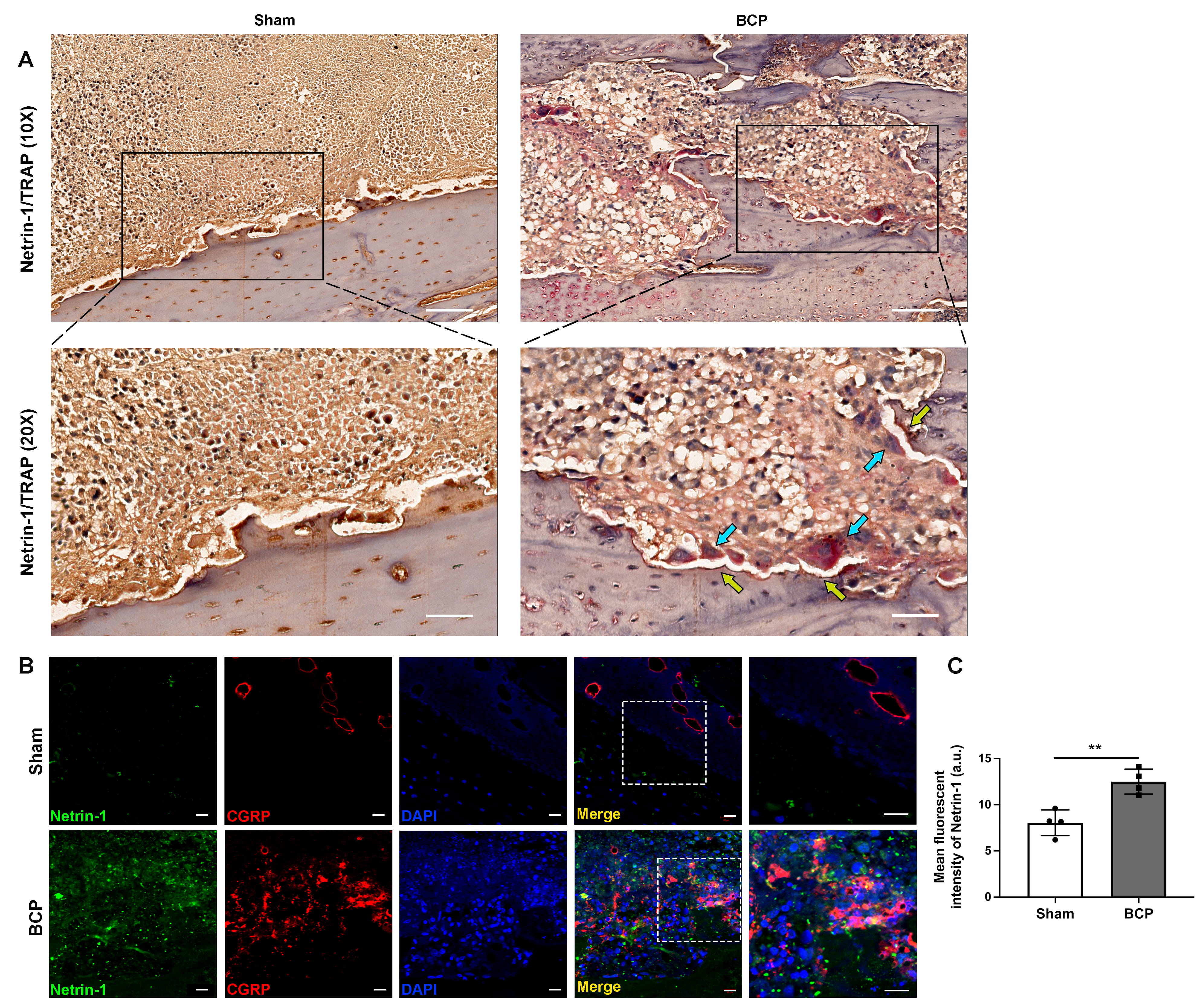 Netrin-1 Role in Nociceptive Neuron Sprouting through