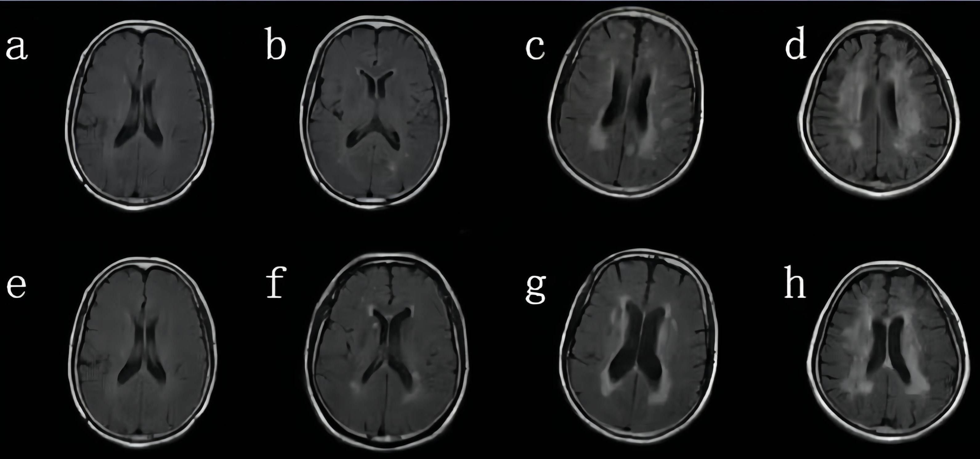 Association of Retinal Nerve Fiber Layer Thickness with Brain  Microstructural Changes in Participants with White Matter Hyperintensities