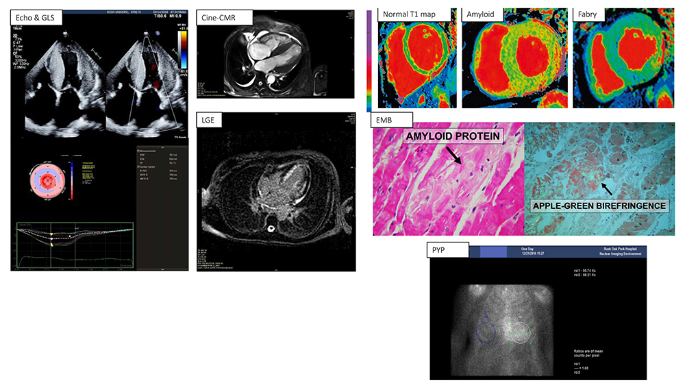 Atypical Case of Wild-Type Cardiac Amyloidosis with Septal Predominance and  a Nonapical Sparing Strain Pattern - CASE