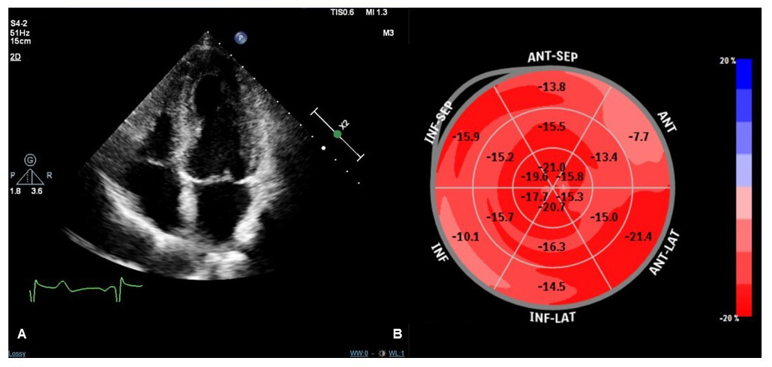 Frontiers  Novel Imaging and Genetic Risk Markers in Takotsubo Syndrome