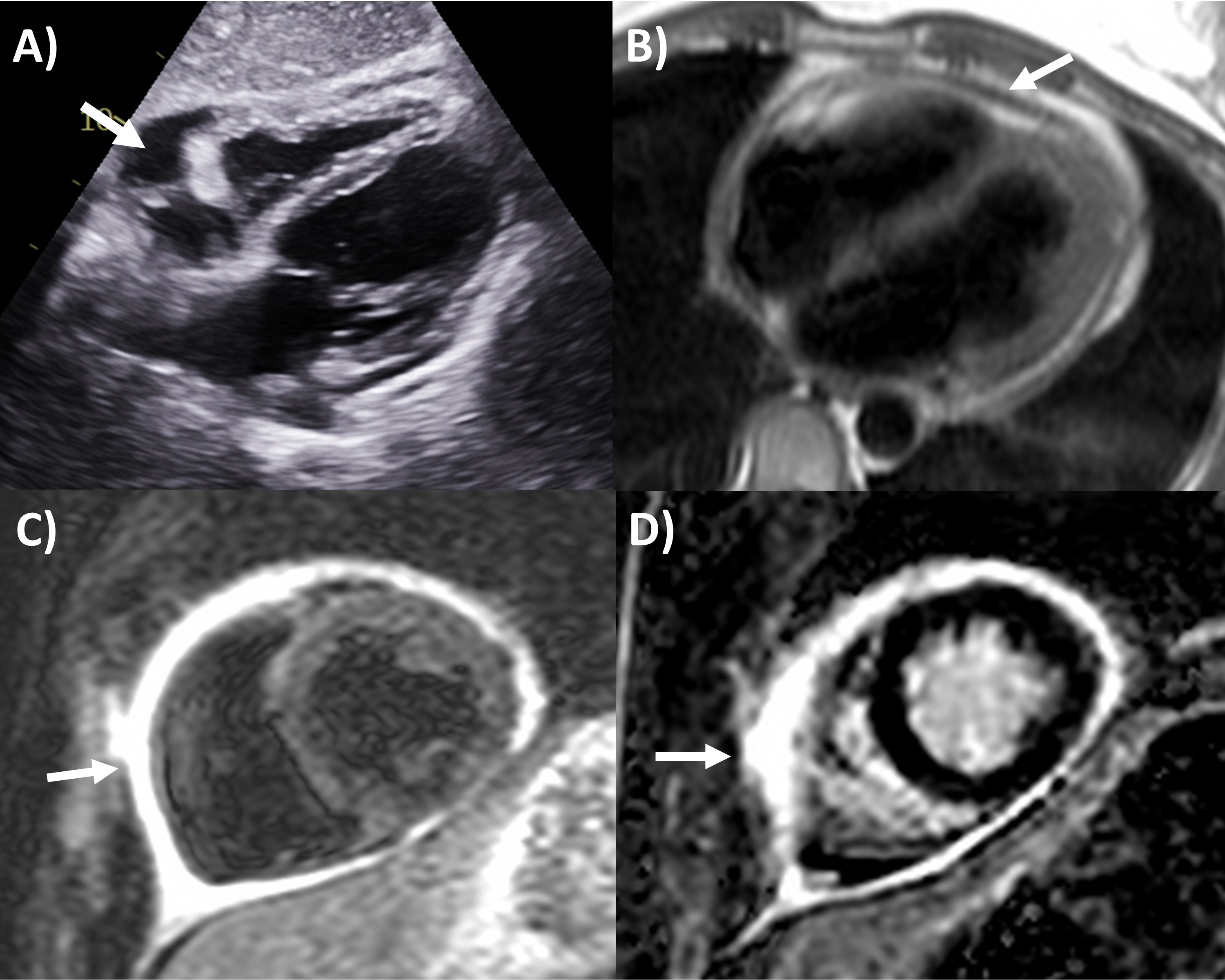 Constrictive Pericarditis Mri