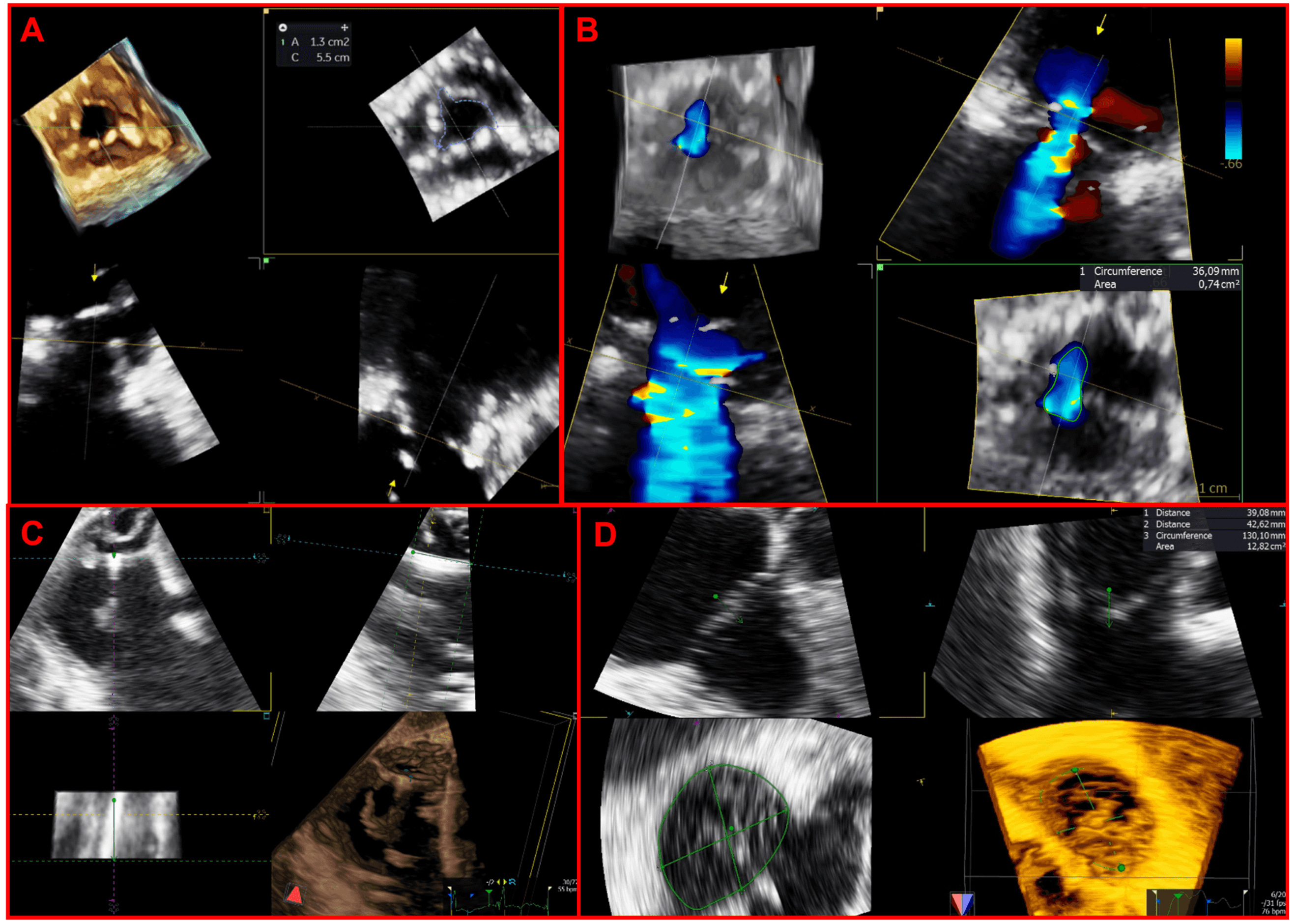 Journal of Cardiovascular CT on X: Agreement is strong between 4D CCT and  speckle tracking echocardiography only for LV global longitudinal strain.  Other features demonstrated mod or weak correlation. #yesCCT