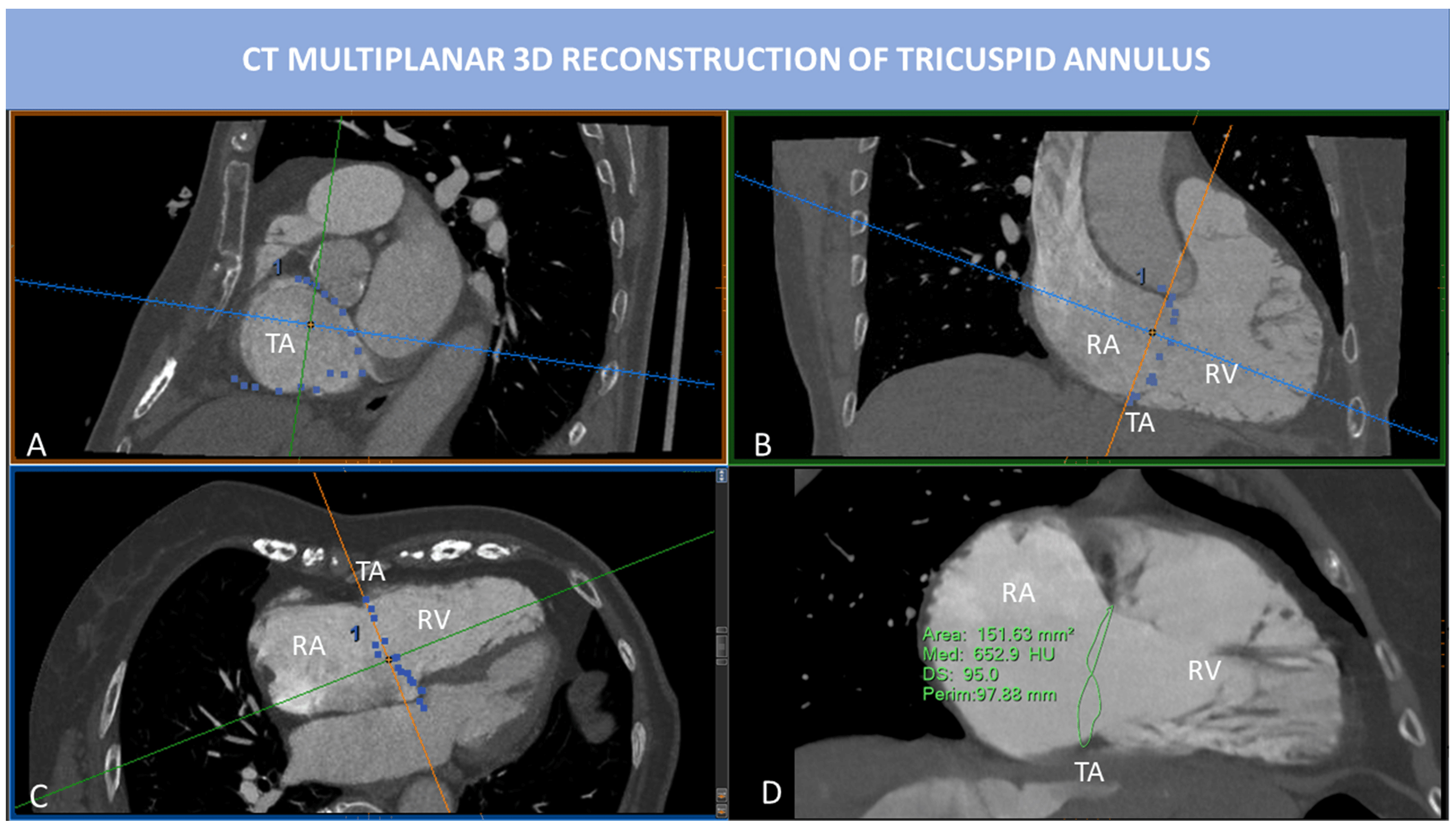 Reproducibility of 4D cardiac computed tomography feature tracking