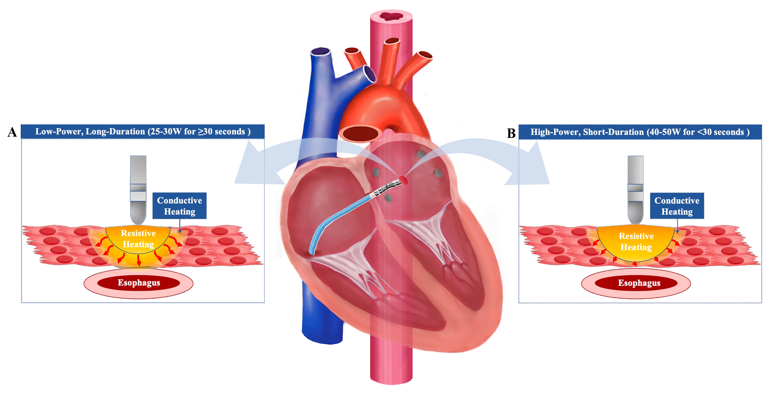 High-power, Short-duration Radiofrequency Compared with Standard  Radiofrequency Ablation