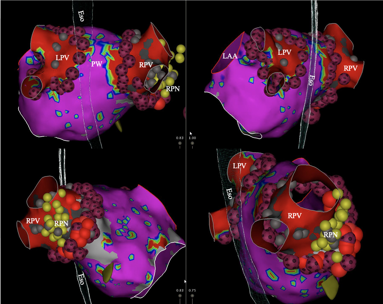 High-Power and Short-Duration Ablation for Pulmonary Vein