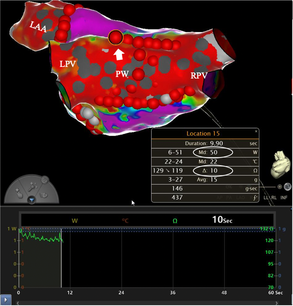 Impact of High-Power Short-Duration Radiofrequency Ablation on Long-Term  Lesion Durability for Atrial Fibrillation Ablation - ScienceDirect