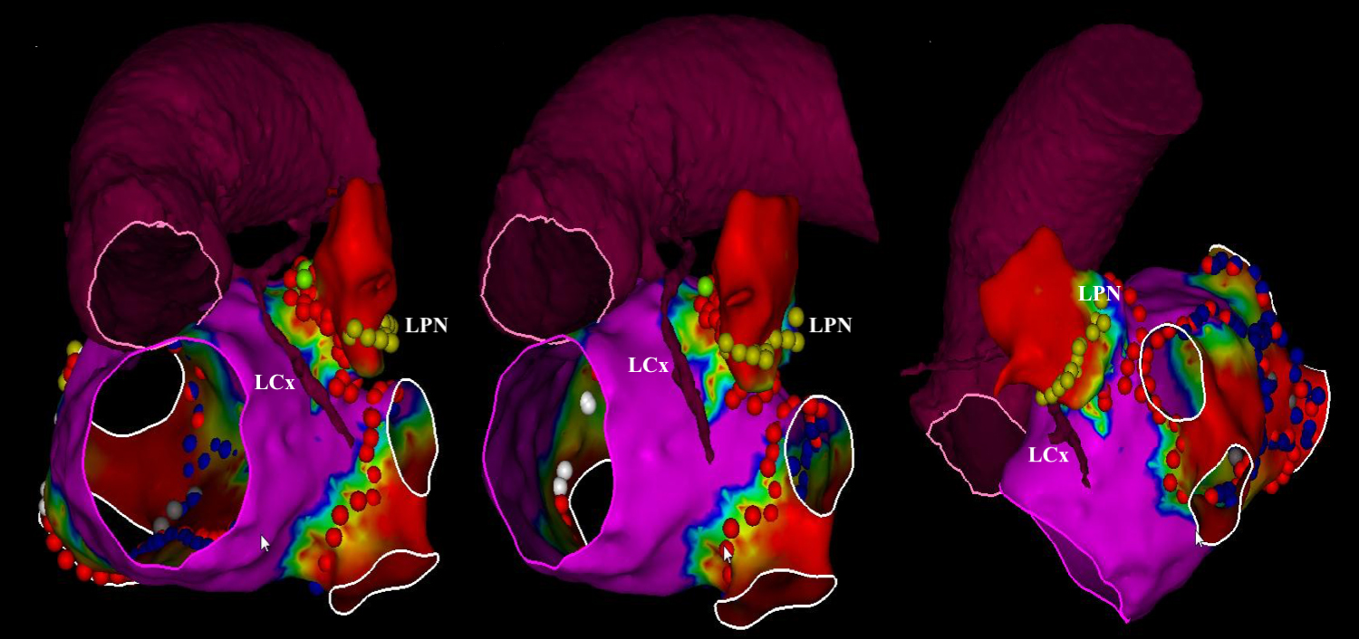 Abstract 174 Safety of ultra high power and short duration ablation with 70  watts over 7 seconds in patients with paroxysmal atrial fibrillation