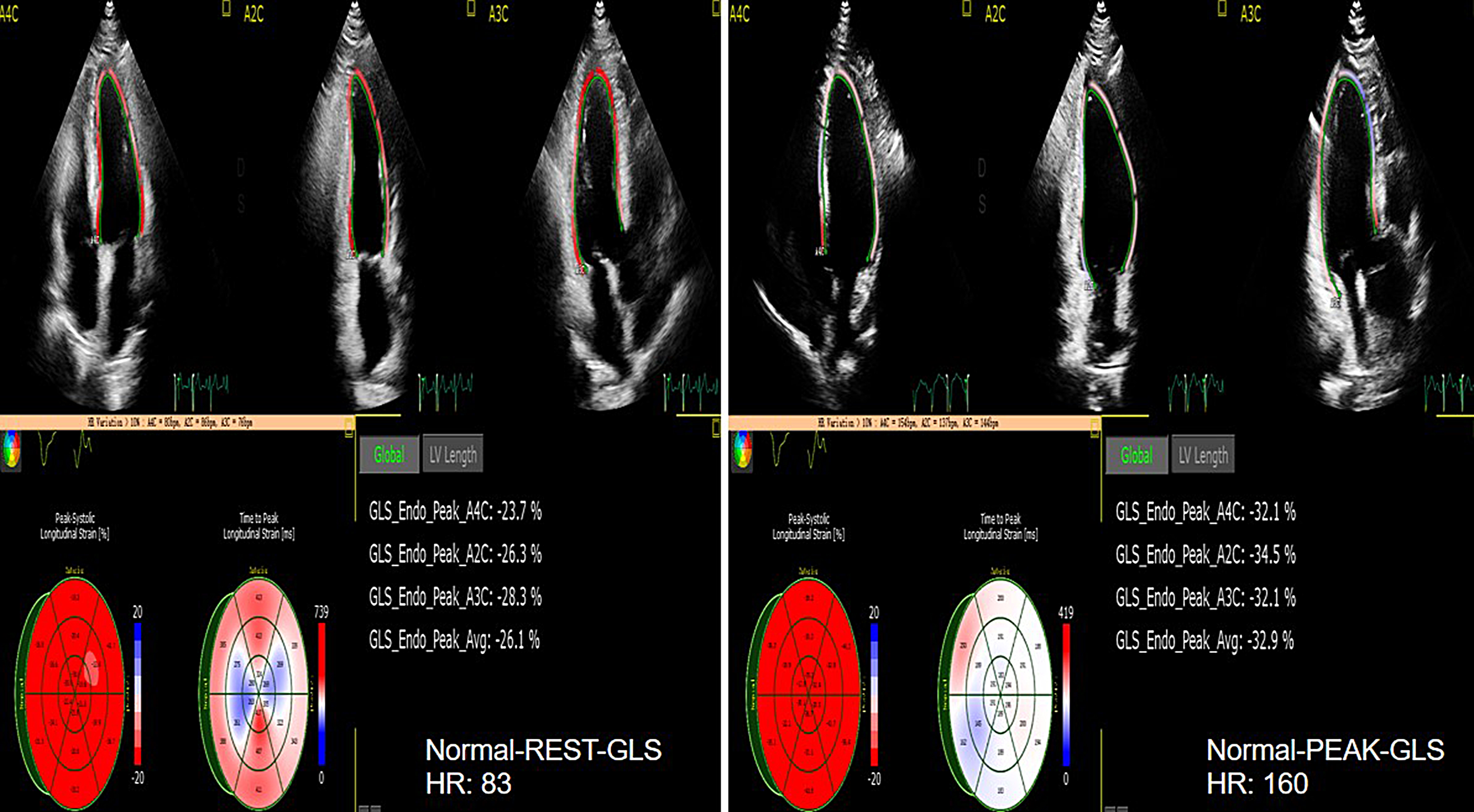 The value of 2D speckle-tracking strain echocardiography in evaluating the  relationship between carotid elasticity and left ventricular systolic  function in patients with diabetic nephropathy, Insights into Imaging