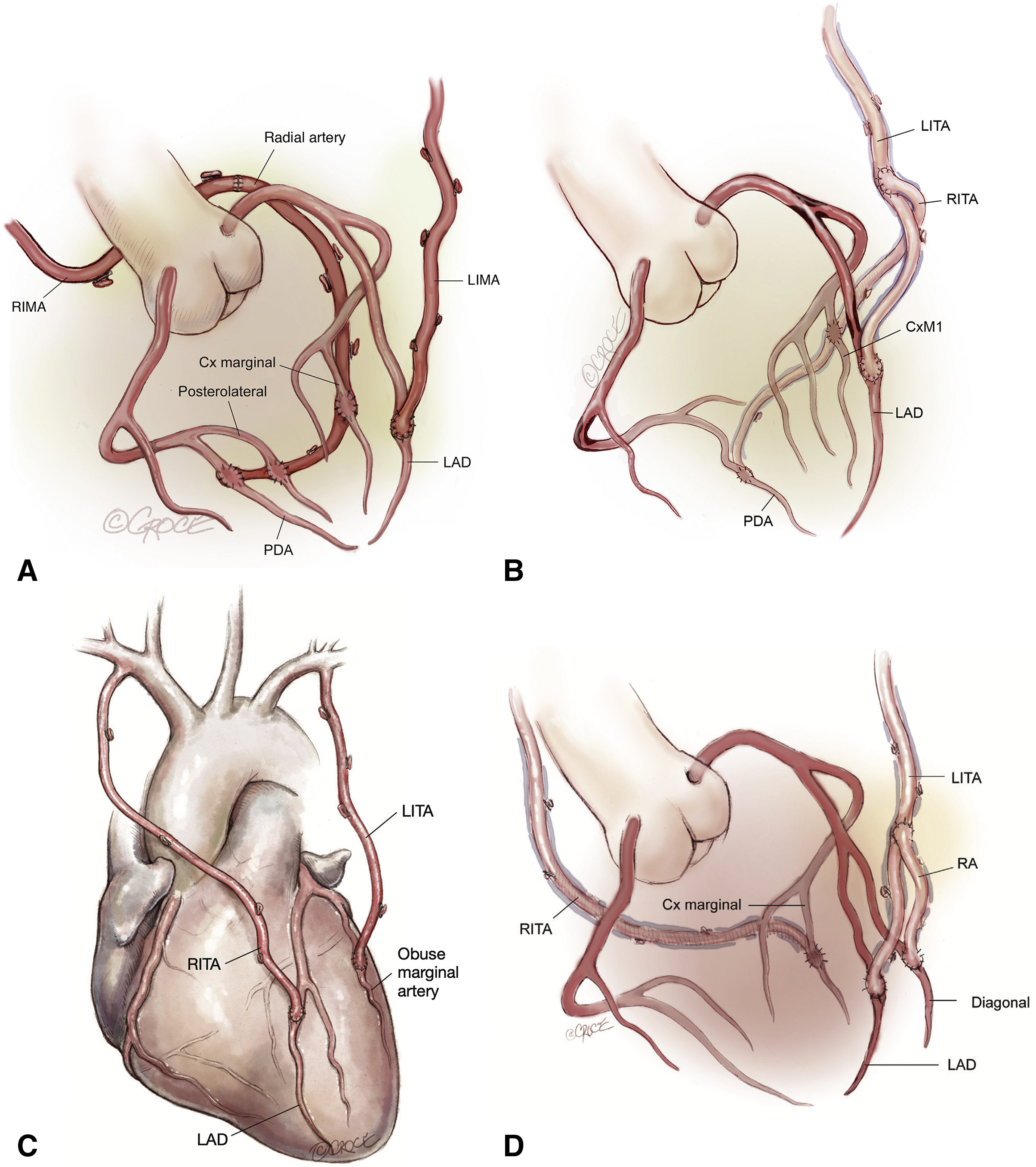 Braz J Cardiovasc Surg - The pulmonary vascular blood supply in