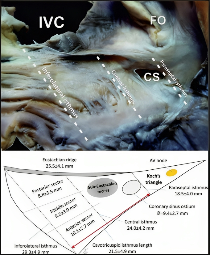 Cavotricuspid Isthmus-Dependent Atrial Flutter. Beyond Simple Linear ...